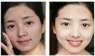  5个帮助加快去痘痘的好习惯