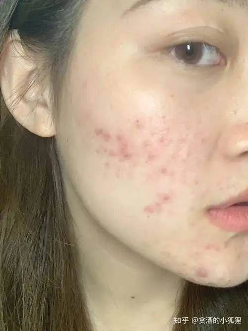  为什么去医院看痘痘,竟然让我先杀菌恶心的痘痘到底怎么去