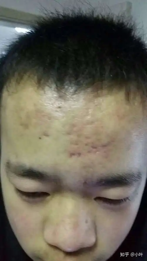  我得痘痘治好了感恩
