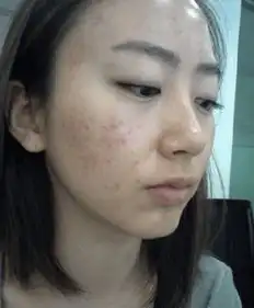 如何淡化痘印的表情包朋