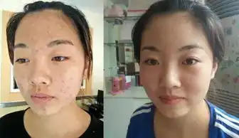  神奇万年痘印都没了这个明星都在用的祛痘神器,24小时祛痘褪斑,还不留印
