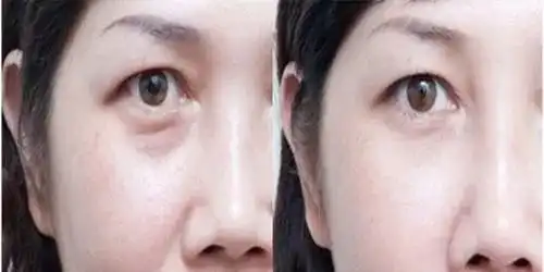  网评备受关注,如何缓解视力模糊淡化黑眼圈,让人轻松入眠的方法