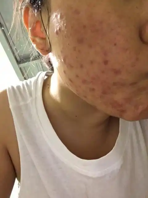  想淡化斑点痘印暗黄的人不得不学春夏季护理