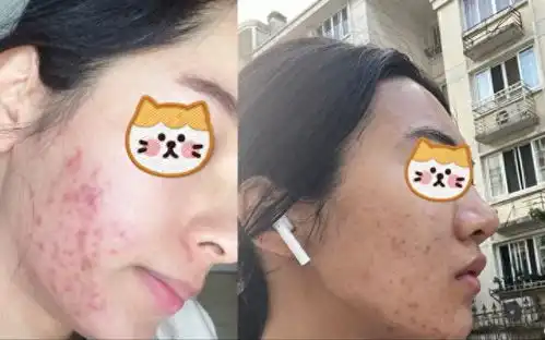  满脸痤疮痘印坑坑洼洼教你1个小妙招,淡化痘印重获自信