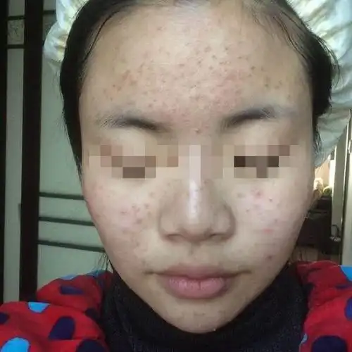  想淡化斑点痘印暗黄的人不得不学春夏季护理