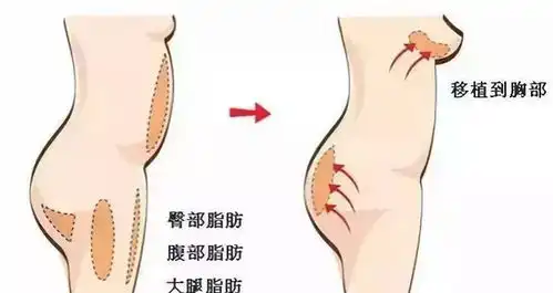  自体脂肪填充到底靠谱吗