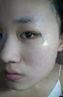  如何让痘印快速消失很便宜的小秘方告诉你,吸出色素淡化痘印