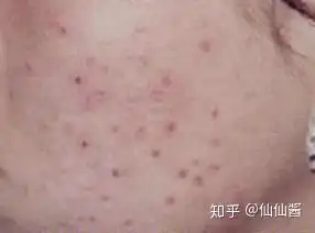  脸上有红色褐色痘印怎么办如何有效淡化脸上的痘印
