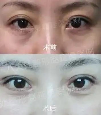  八大处整形专家赵延勇,揭秘延禧攻略中整容脸为何表情僵硬