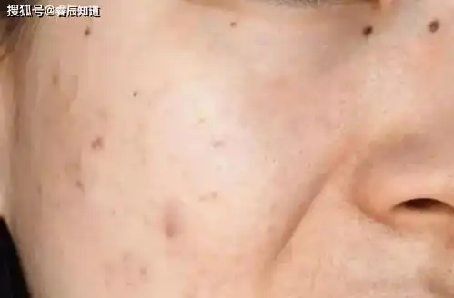  皮肤问题千千万,唯有长痘最讨厌