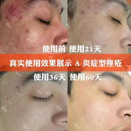  祛痘膏正品青春痘粉刺神器去痘印面霜痘肌修复霜淡化痘印女学生男