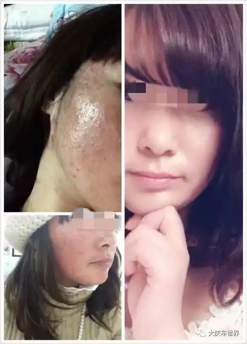  580元包治粉刺痤疮青春痘,免费体验三次效果会说话