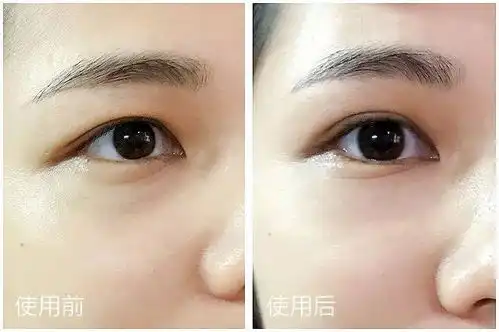  网评备受关注,如何缓解视力模糊淡化黑眼圈,让人轻松入眠的方法