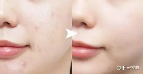  如何有效淡化脸上的痘印