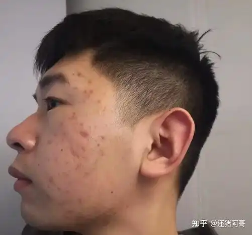  我脸上出的油可以炸油条了,还闷出好多痘痘,该怎么办