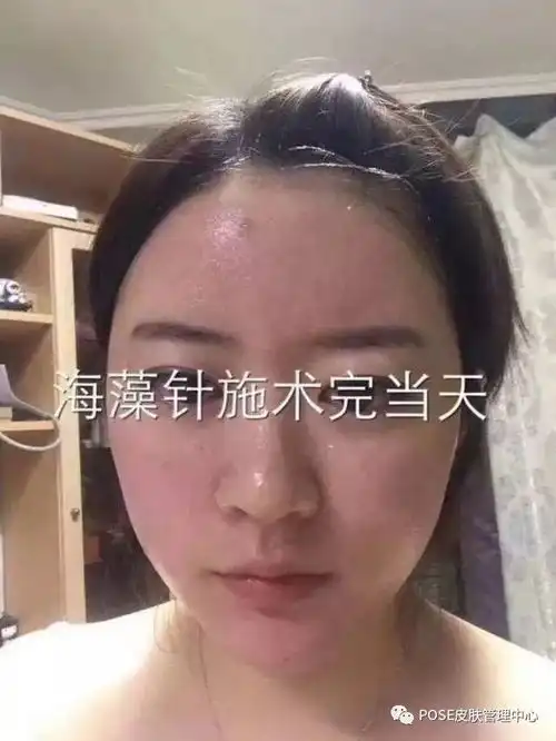  有一种修复修复痘坑痘印去粉刺的管理海藻焕肤