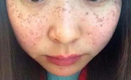  想淡化斑点痘印暗黄的人不得不学春夏季护理