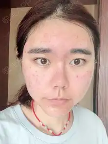  读书时长的痘留下了一脸的坑和印子,翻了知乎豆瓣各种...祛痘痘坑痘印悦美整形