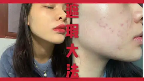 如何淡化痘印的表情包艾