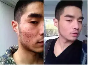 如何淡化痘印的表情包真