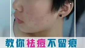  一个月淡化39痘印倩碧302镭射瓶真实情况反馈