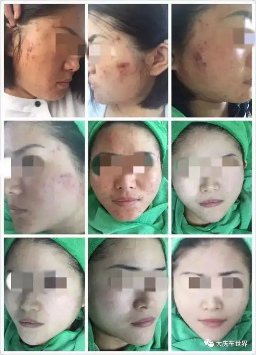  580元包治粉刺痤疮青春痘,免费体验三次效果会说话
