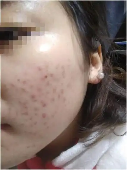  想淡化斑点痘印暗黄的人不得不学春夏季护理