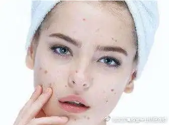  表情怎么祛痘痘痘印表情