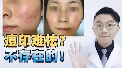  针清痘印30天快速淡化祛痘印干货看完和痘印说拜拜简单高效又省钱超温和护理方法