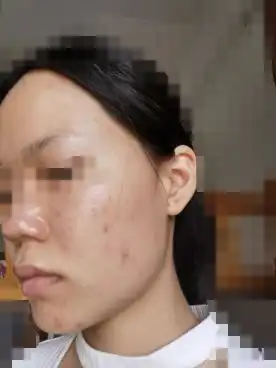  针对性祛痘用户实测反馈大合集第二期