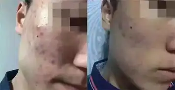  战痘好物使用报告这款祛痘精华除了淡化陈年痘印,还能提亮肤色