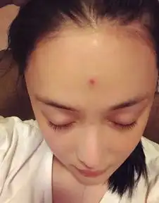  张馨予被痘痘折磨20天,微博求助如何去痘印