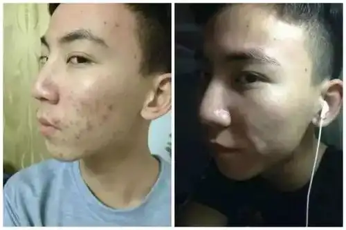 如何淡化痘印的表情包美